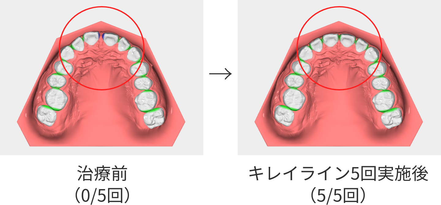 キレイライン5回実施後