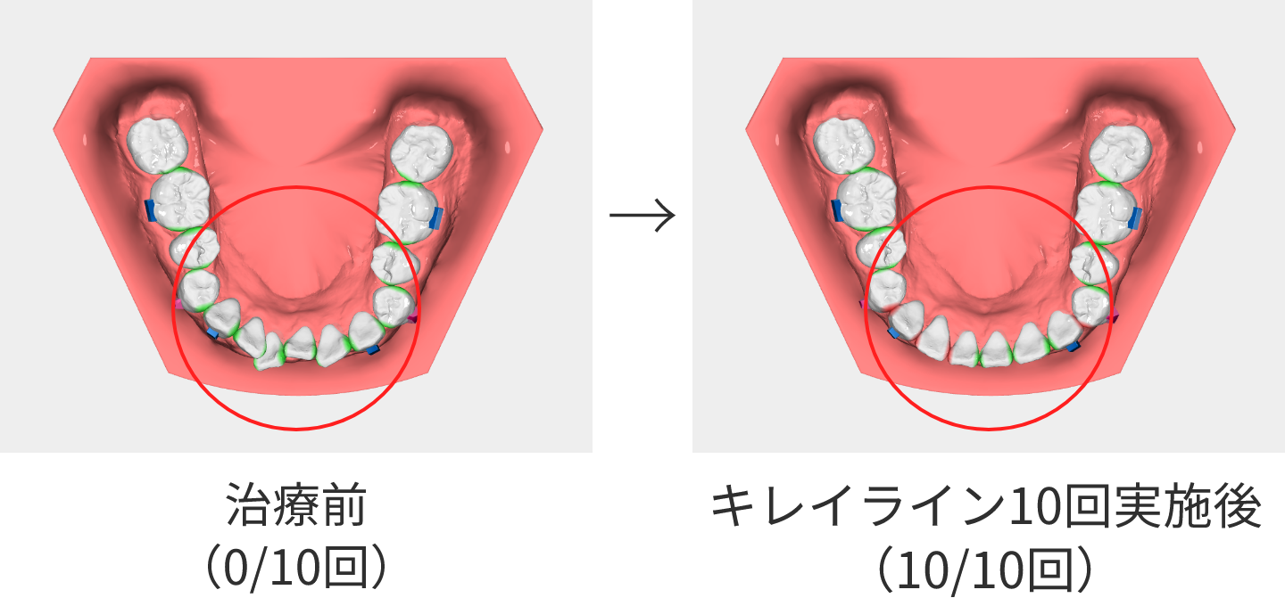 キレイライン10回実施後