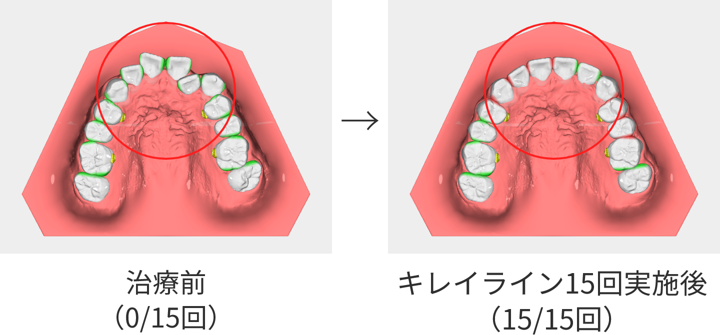 キレイライン15回実施後